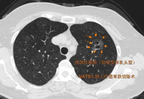 肺部疑似磨玻璃结节？请保持警惕！
心脏疾病？别让磨玻璃结节误诊！