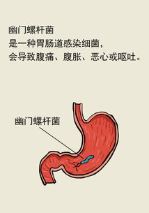 中山大学研究团队揭示：根除幽门螺杆菌可显著提升胃癌患者的生存率