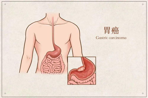 中山大学研究团队揭示：根除幽门螺杆菌可显著提升胃癌患者的生存率