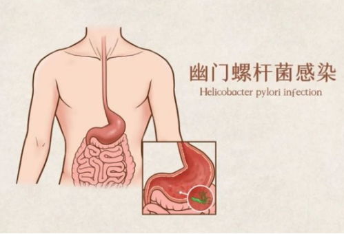 中山大学研究团队揭示：根除幽门螺杆菌可显著提升胃癌患者的生存率