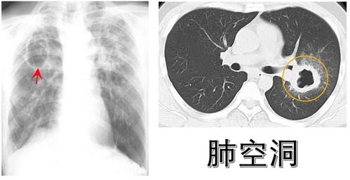 结核杆菌与HIV：一对联手的「杀手」病毒，破坏我们的免疫系统