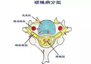 颈部疼痛：是否真的是颈椎病？四个关键点了解一下