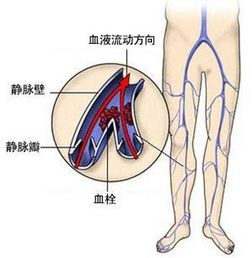 提高腿部静脉曲张警惕：鼓包问题的两个风险与解决方法