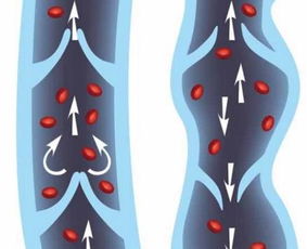 提高腿部静脉曲张警惕：鼓包问题的两个风险与解决方法