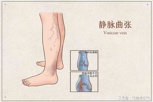 提高腿部静脉曲张警惕：鼓包问题的两个风险与解决方法