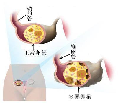 成都生物所研究出多囊卵巢综合症新型治疗药物，有望成为未来发展重要里程碑！