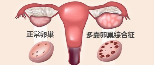 成都生物所研究出多囊卵巢综合症新型治疗药物，有望成为未来发展重要里程碑！