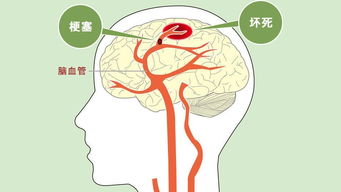 辨别脑梗死风险，掌握3个简单的检查方式