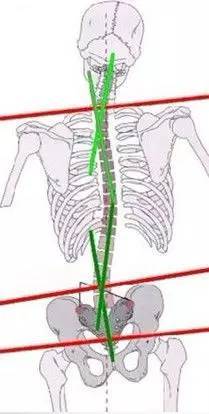 呵护脊柱健康：四要素助力预防和治疗脊柱侧弯与高低肩问题