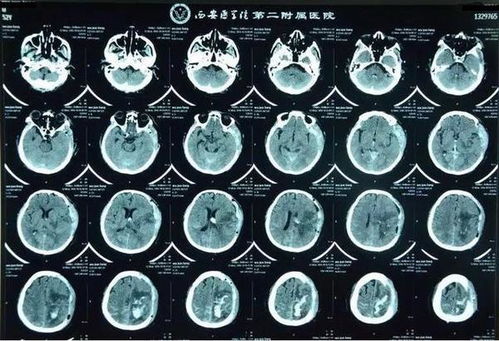 挽救生命：脑出血患者的「黄金救援期」与识别方法是什么？