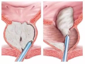 及时了解前列腺增生常用药物：两种有效且效果显著的药物选择