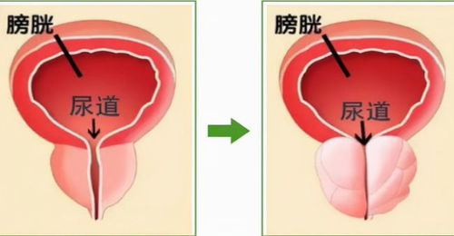 及时了解前列腺增生常用药物：两种有效且效果显著的药物选择