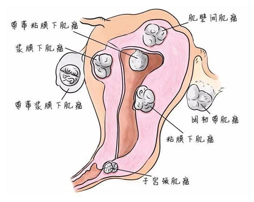 关于子宫肌瘤的健康提示：了解大多数良性情况，及时发现并治疗