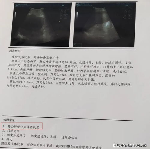 朴宝蓝的肝硬化、脂肪肝与急性酒精中毒尸检报告出炉