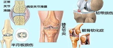 科学认知：下楼膝盖疼痛可能致髌骨软化症，按部就班的康复方式可助您有效恢复