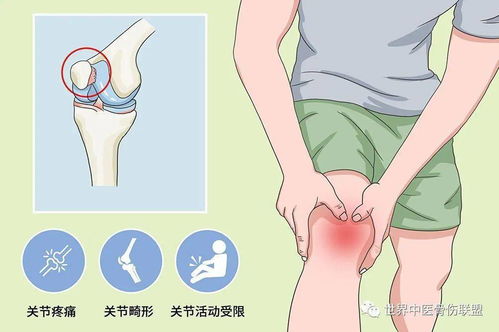 科学认知：下楼膝盖疼痛可能致髌骨软化症，按部就班的康复方式可助您有效恢复