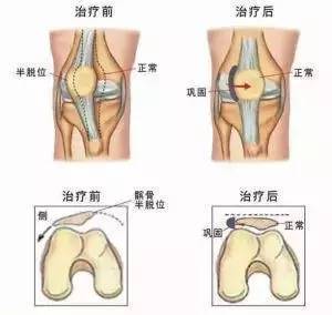 科学认知：下楼膝盖疼痛可能致髌骨软化症，按部就班的康复方式可助您有效恢复