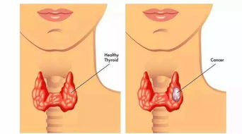 警惕！8大症状预示甲状腺癌，了解预防措施很重要！