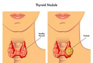 警惕！8大症状预示甲状腺癌，了解预防措施很重要！