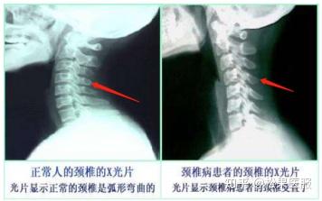 【悬垂式】颈椎疗法：治愈与疯狂的抉择