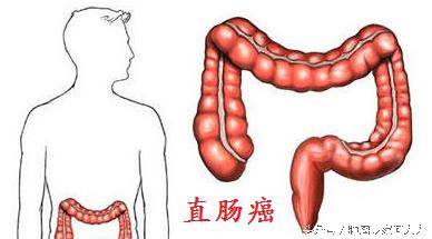 杭州15岁男生确诊直肠癌，病情恶化至突发性大便出血！医生紧急提醒