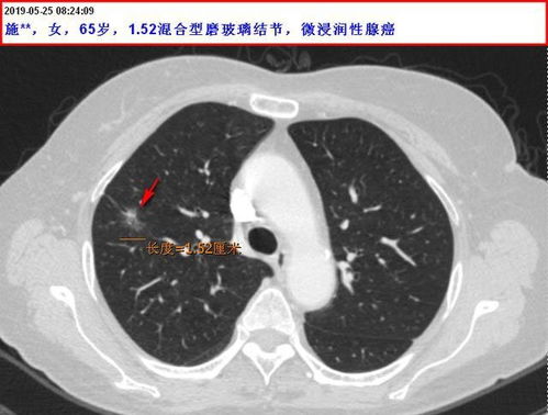 活得好不好取决于你的选择：40岁发现自己肺部有结节，未来几年可否保持健康？