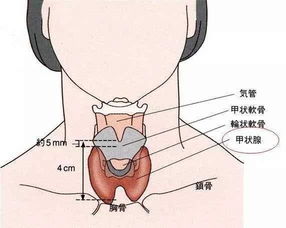 世界甲状腺日：甲状腺结节的疑虑与治疗 | 医本正经