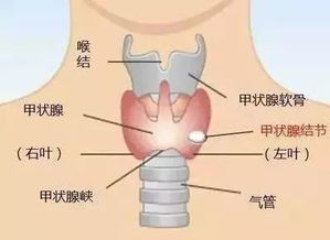 世界甲状腺日：甲状腺结节的疑虑与治疗 | 医本正经