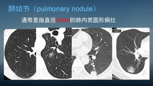 如何判断肺实性结节的消失与转化：探讨癌症风险因素及解决方案