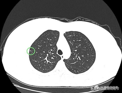 如何判断肺实性结节的消失与转化：探讨癌症风险因素及解决方案