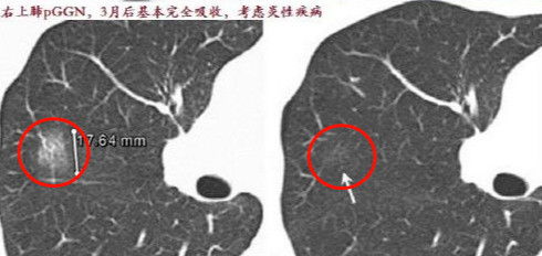 如何判断肺实性结节的消失与转化：探讨癌症风险因素及解决方案