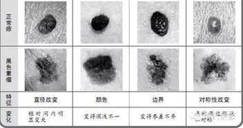 抵御黑色素瘤，从提升防晒意识开始 - 英机构呼吁加大宣传力度