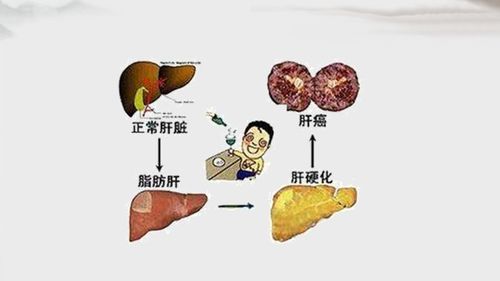 戒酒后多长时间可恢复肝脏健康：一次全面的指南