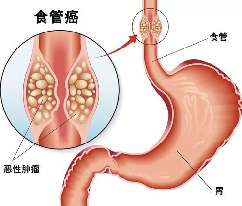 福建高发！了解癌症早期症状！早发现能救人性命

请注意，这里的仅供参考，任何医疗建议都应在专业医生的指导下进行。如果您或您身边的人有健康问题，强烈建议您寻求医生的帮助。