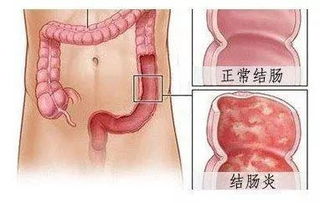 溃疡性结肠炎的新治疗方法：三种创新菌株即将上市，影响溃疡性结肠炎的自愈与复发风险