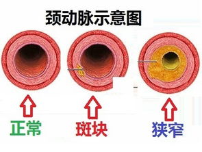 颈部动脉斑块：了解可能的逆转可能性与应对措施