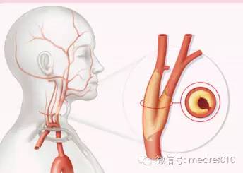 颈部动脉斑块：了解可能的逆转可能性与应对措施