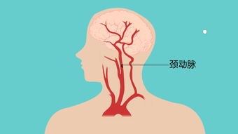 颈部动脉斑块：了解可能的逆转可能性与应对措施