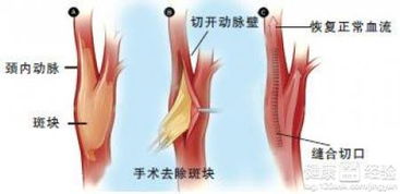 颈部动脉斑块：了解可能的逆转可能性与应对措施