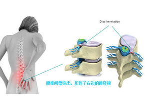 教你轻松应对腰椎间盘问题，这个动作助你舒缓腰痛