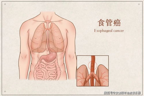 吞咽困难、声嘶哑与食道癌：警惕以上症状，要警惕早期风险！

了解更多关于吞咽问题的详细信息和防止食道癌的建议。