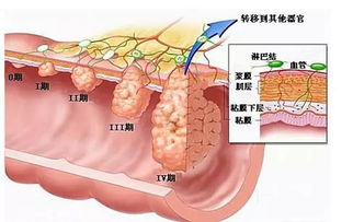 结直肠息肉与肠癌：消化科专家的深度解析，一起关注世界肠道日！