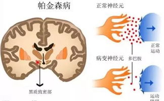 潜在重大突破！姜可能成为帕金森病的新疗法