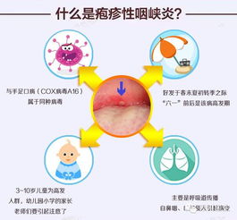 疱疹性咽峡炎：警惕并防范孩子突发的手足口病！详尽家长应对全攻略