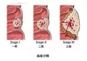 做好一件事 肠癌就成了最好的防癌工具