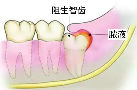 孕妇妊娠期间牙龈炎的预防与治疗，建议到松山医院进行口腔保健。