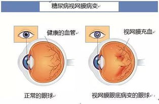 糖尿病视网膜病变的危险信号：及早发现并治疗是关键