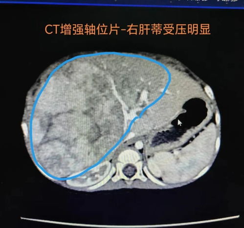 福建1岁男童肝脏肿瘤严重至2/3长满，主刀医生称手术极其凶险