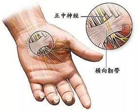 关于手部麻木：警惕可能的健康问题