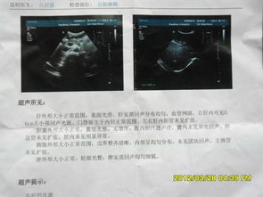 探究早期肝硬化的无声信号: 肝硬化的彩超检查分析